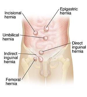Robotic assisted inguinal and femoral hernia in a female patient