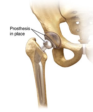 Hip Replacement Surgery (Total Hip Arthroplasty) - Schulze Orthopedics